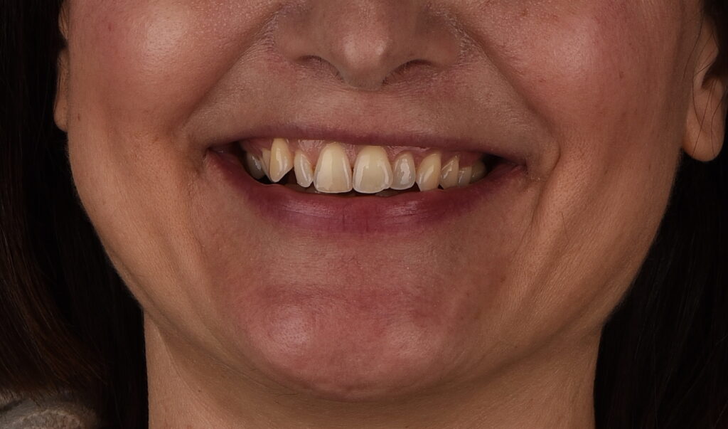 Sbiancamento Dentale, Dentista sbiancamento, Sbiancamento denti