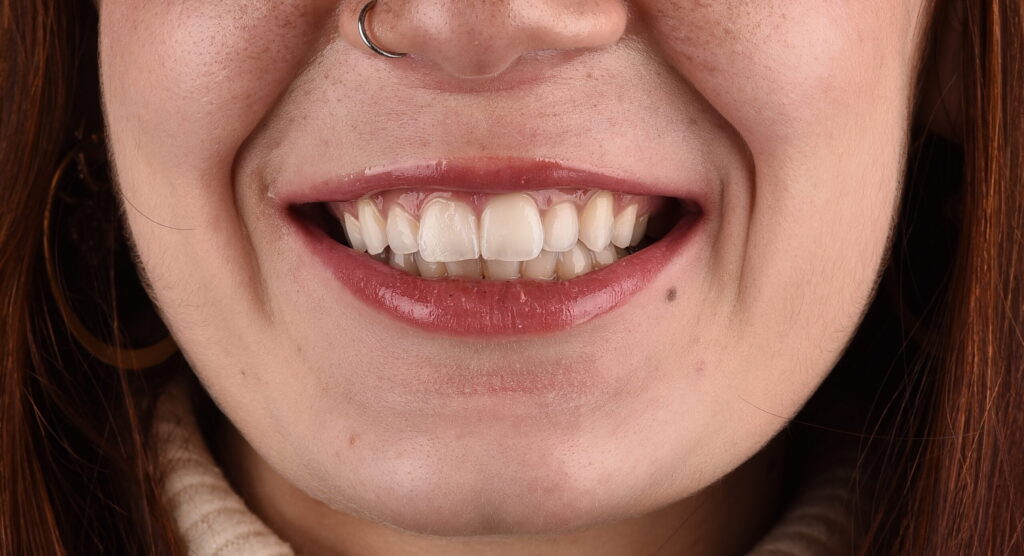 Sbiancamento Dentale, Dentista sbiancamento, Sbiancamento denti