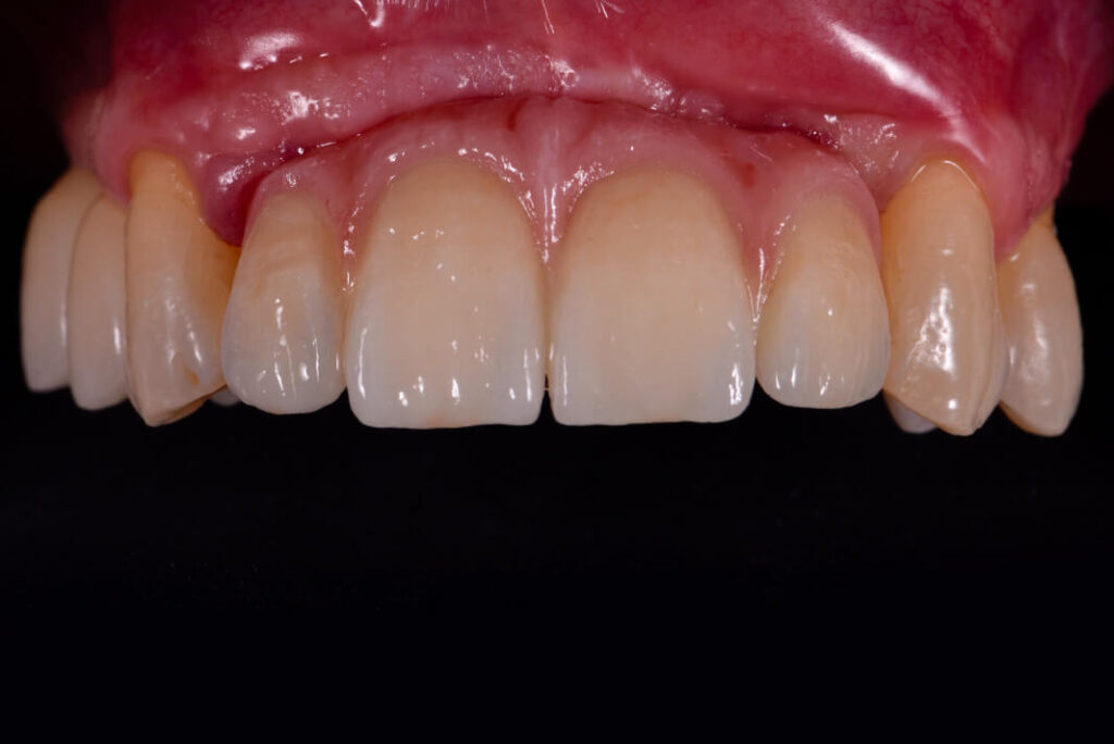 Implantologia dentale. Implantologia dentaria, Implantologia Bologna