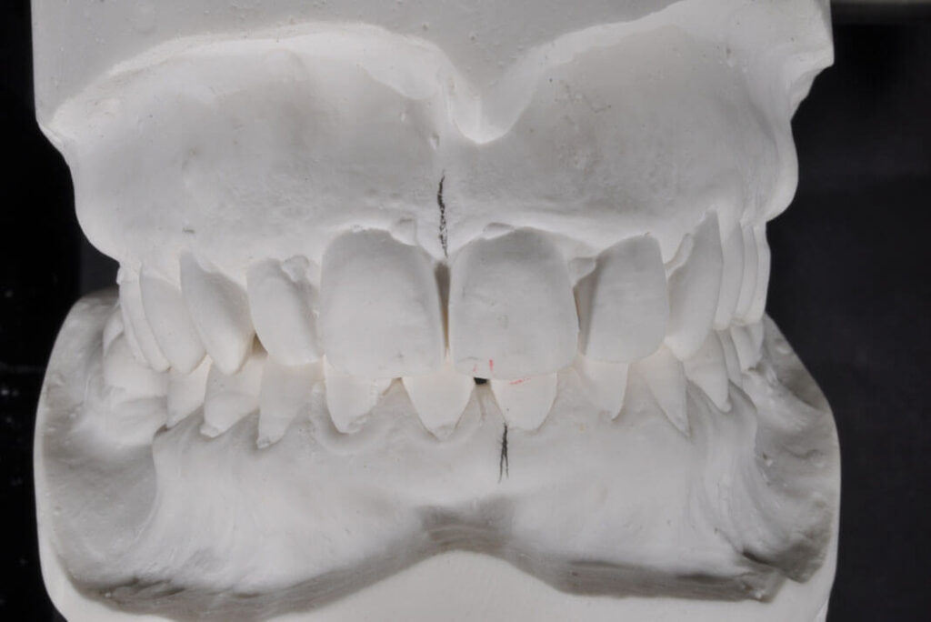 Implantologia dentale. Implantologia dentaria, Implantologia Bologna
