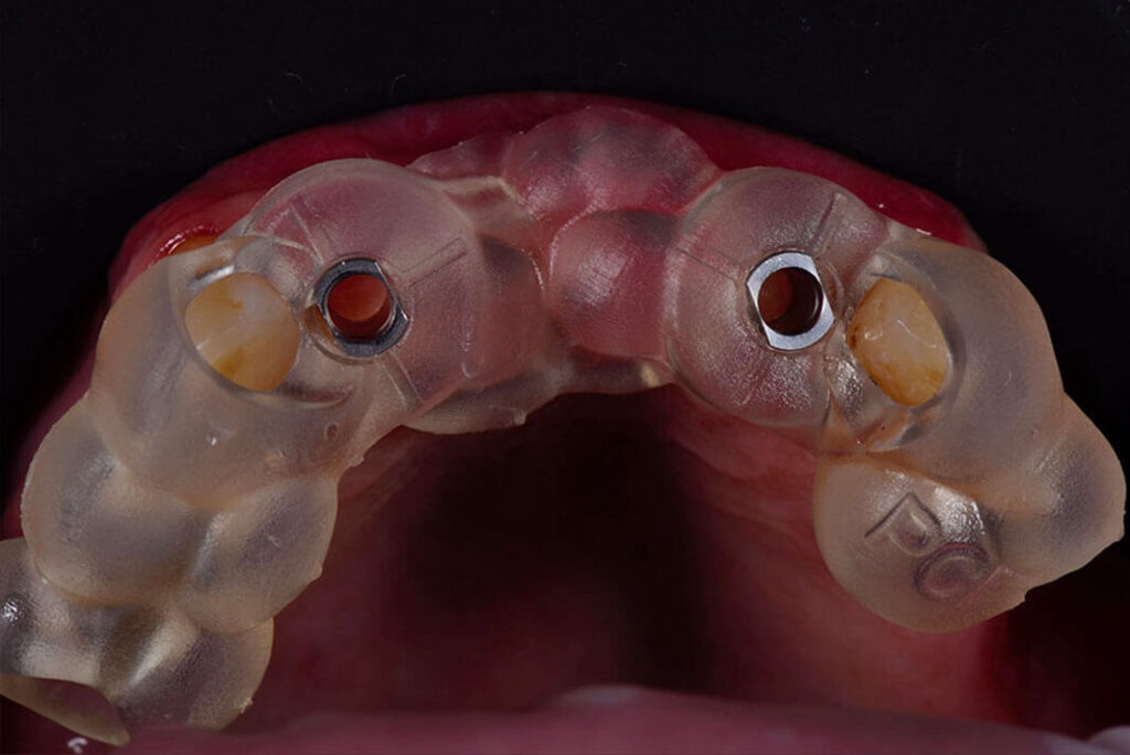Implantologia dentale. Implantologia dentaria, Implantologia Bologna