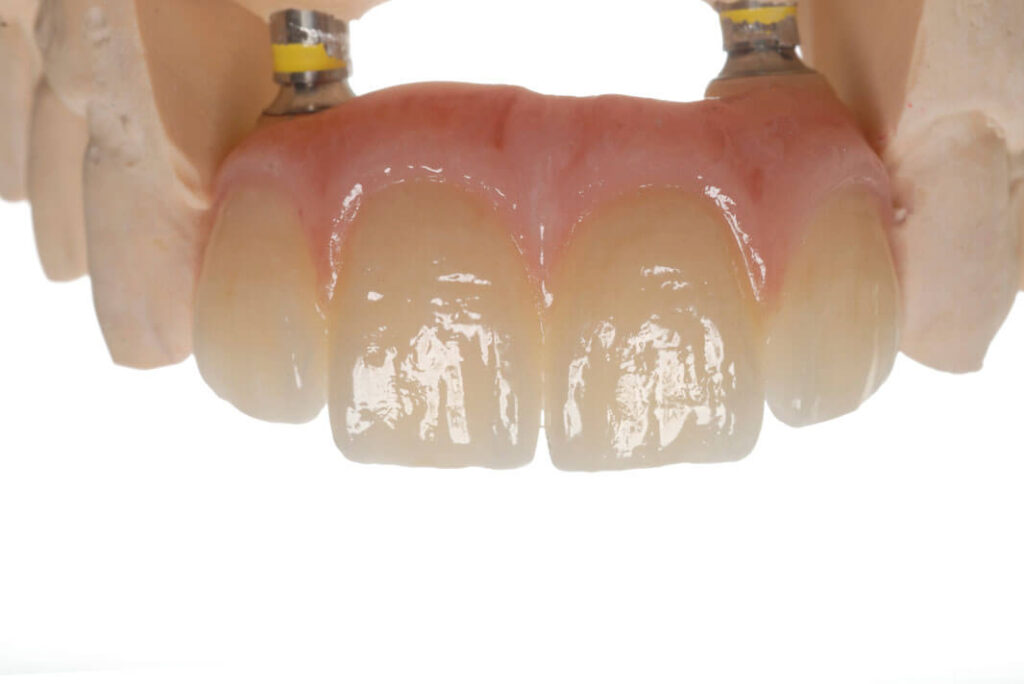 Implantologia dentale. Implantologia dentaria, Implantologia Bologna