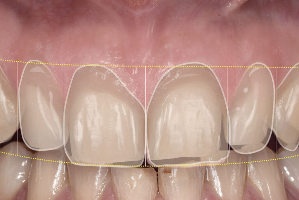 Implantologia dentale. Implantologia dentaria, Implantologia Bologna