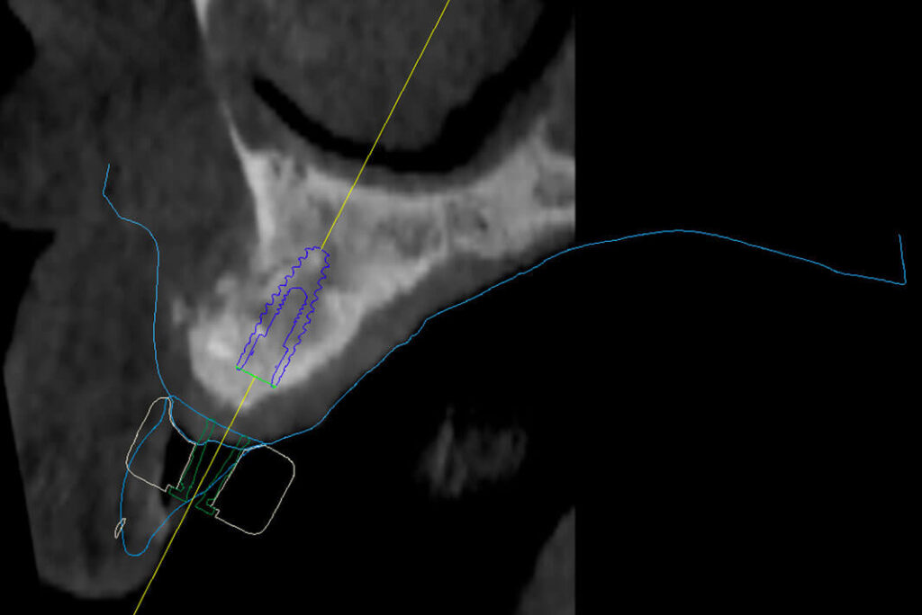 Implantologia dentale. Implantologia dentaria, Implantologia Bologna