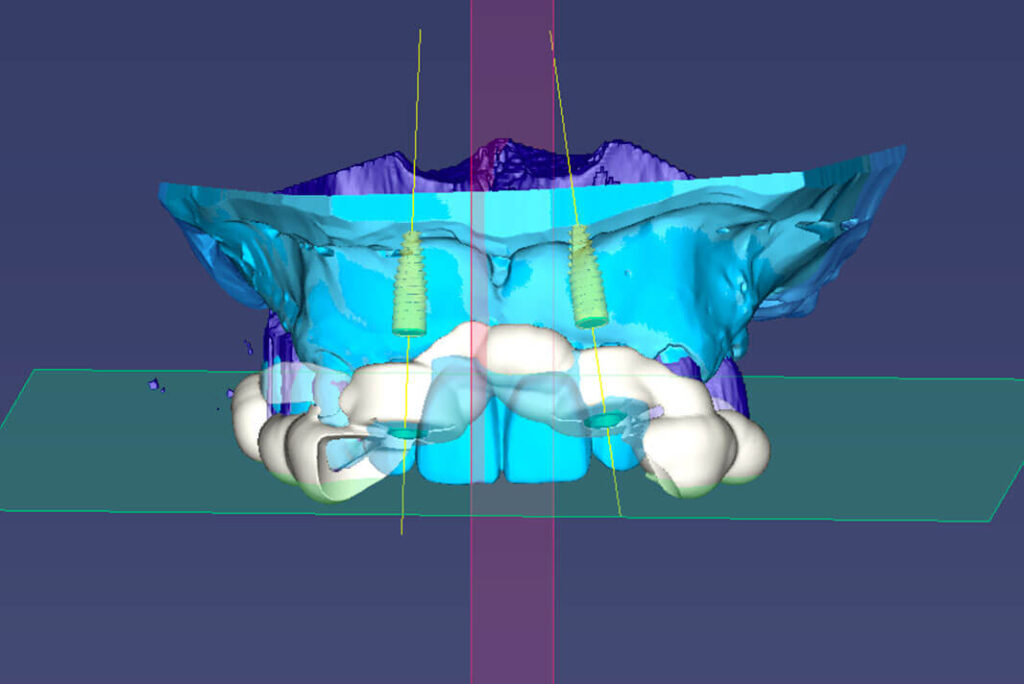 Implantologia dentale. Implantologia dentaria, Implantologia Bologna