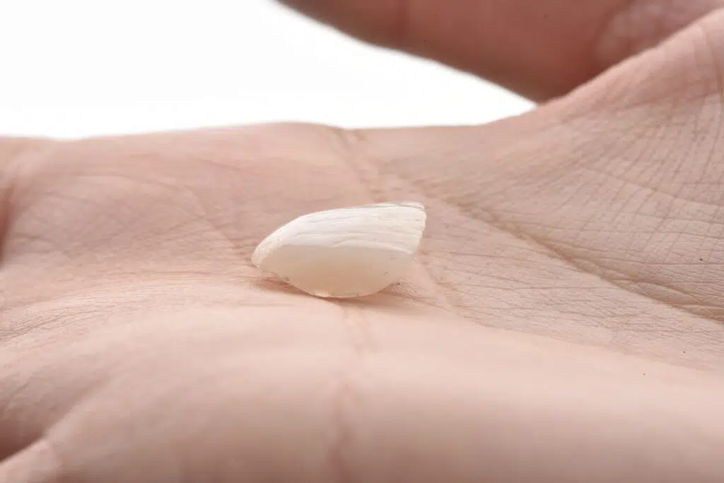 Denti con faccette: la procedura delle faccette denti passo per passo