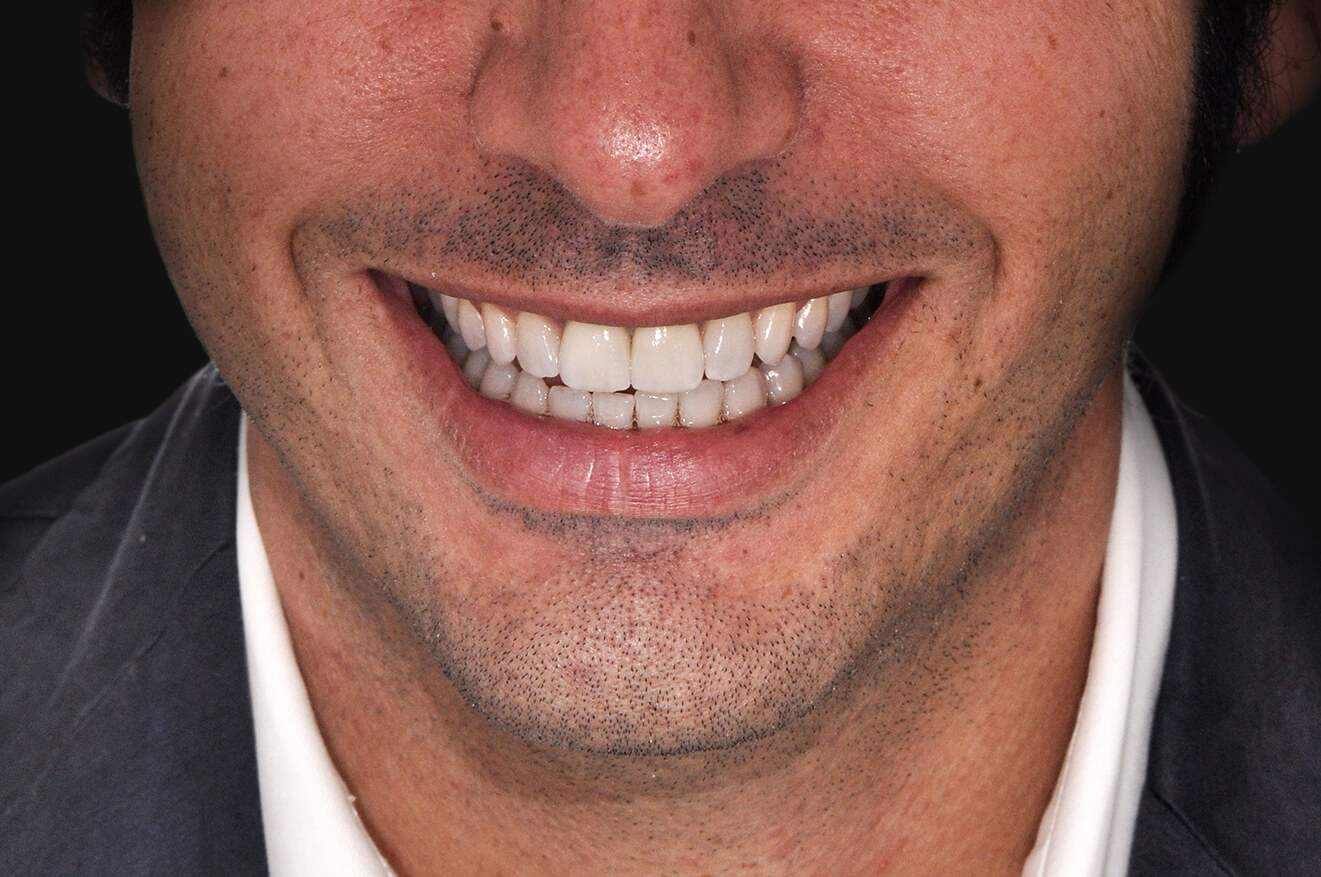 Apparecchio trasparente e faccette dentali