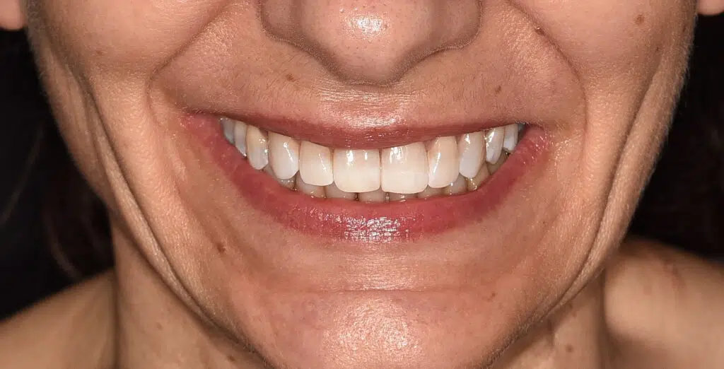 Sbiancamento dentale: Consigli Pratici per Mantenere il Risultato dello Sbiancamento Denti