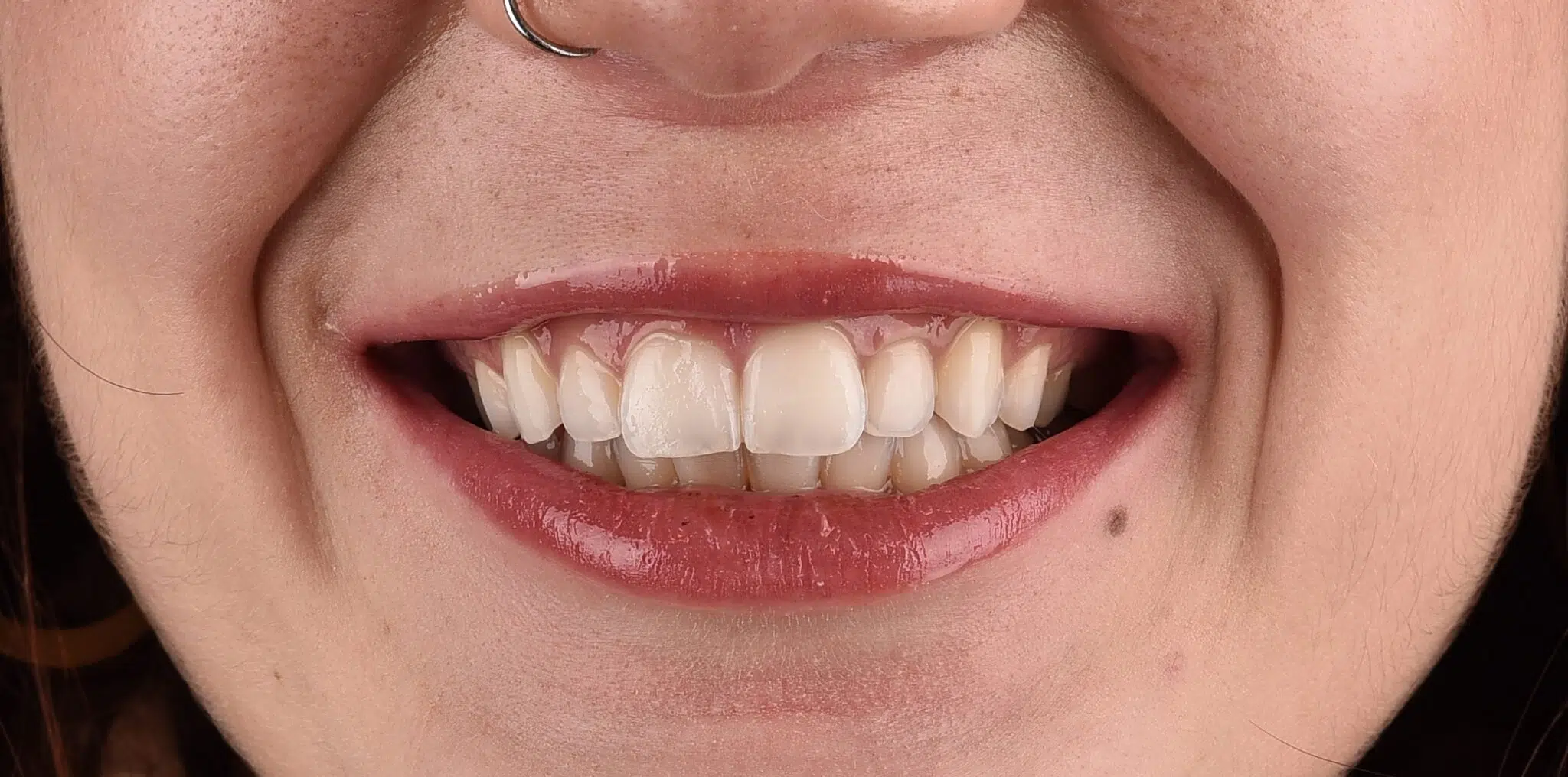 Sbiancamento Dentale Professionale: Cosa Devi Sapere Prima di Provarlo