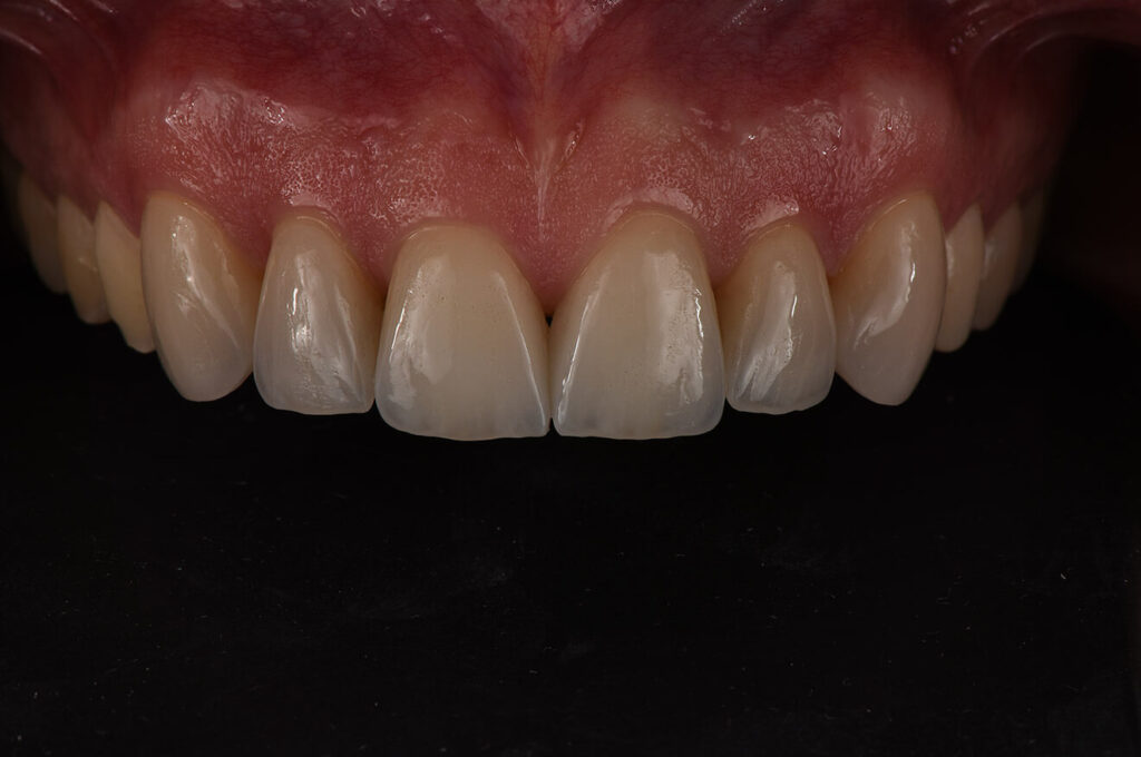 Denti con faccette, Faccette dentali Bologna