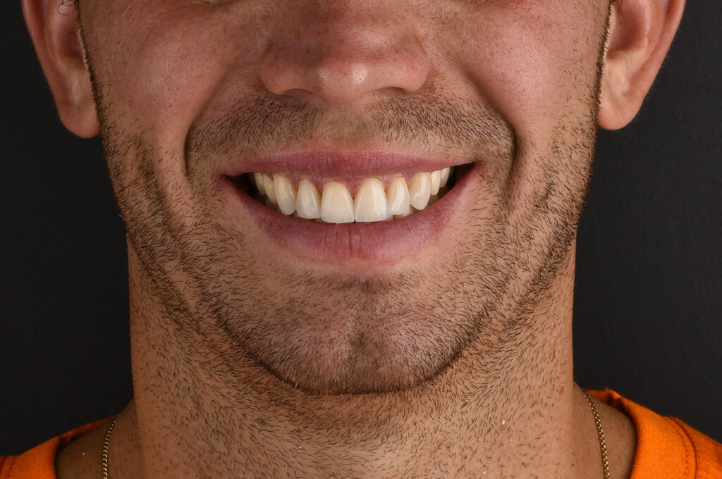 Apparecchio trasparente e faccette dentali