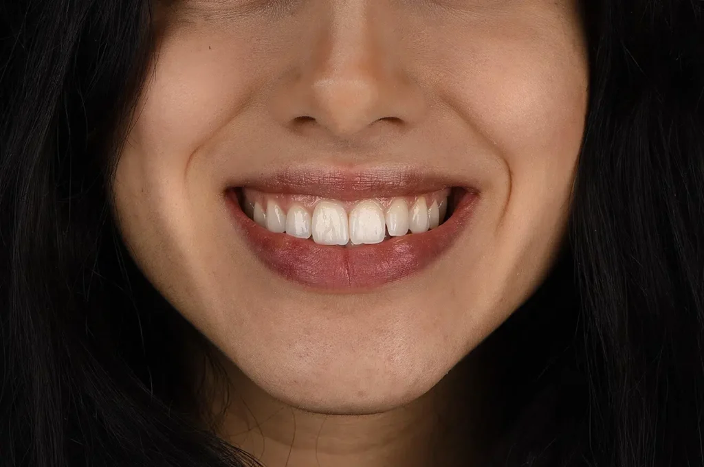 Sbiancamento Dentale: La Guida Completa per un Sorriso Luminoso