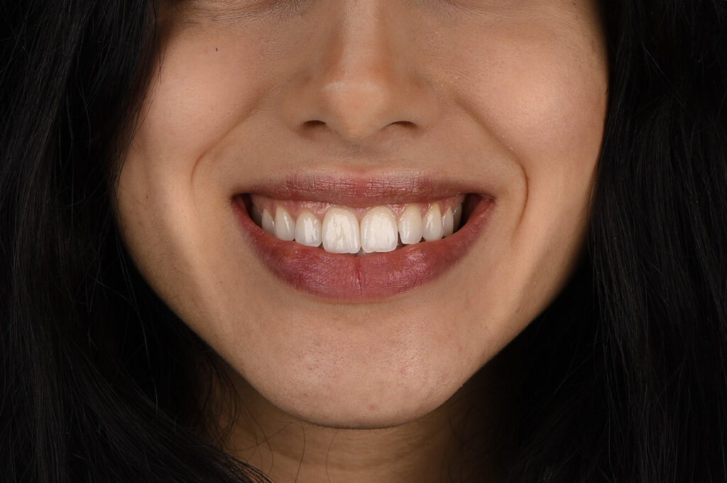 Otturazioni Estetiche 21 Otturazione dente, Otturazione carie, Otturazione estetica