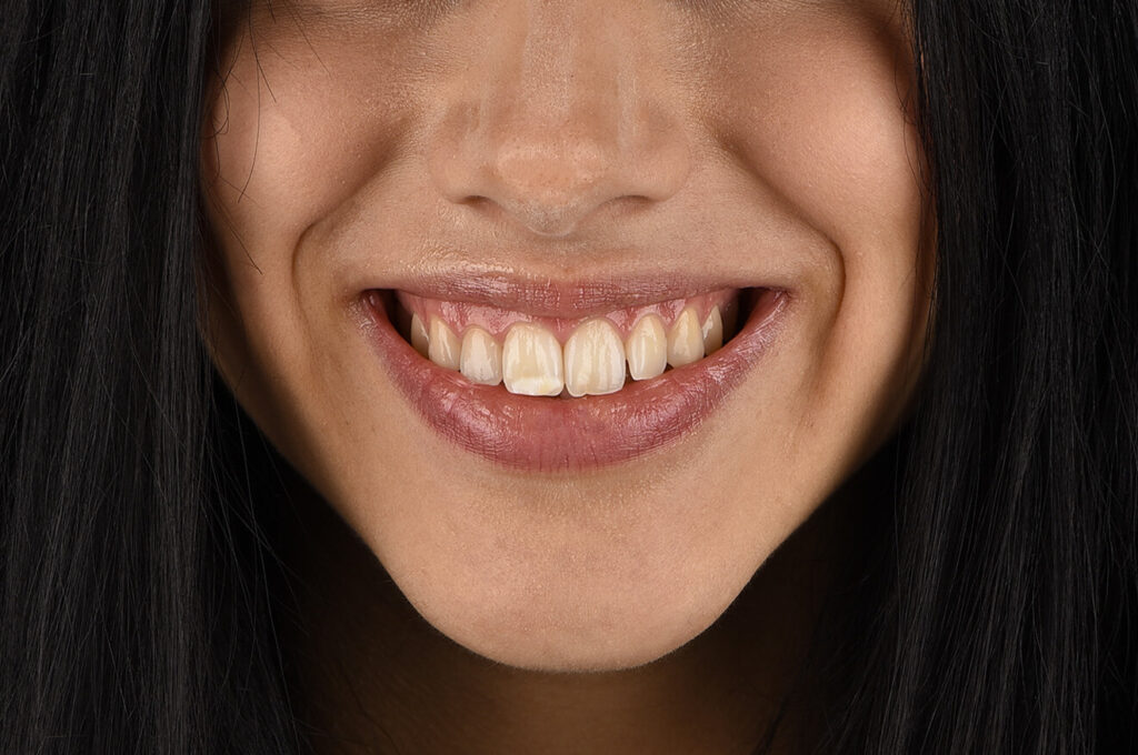 Otturazioni Estetiche 20 Otturazione dente, Otturazione carie, Otturazione estetica