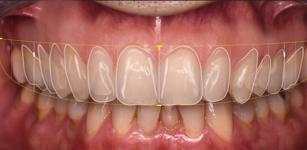estetica dentale, denti estetici
