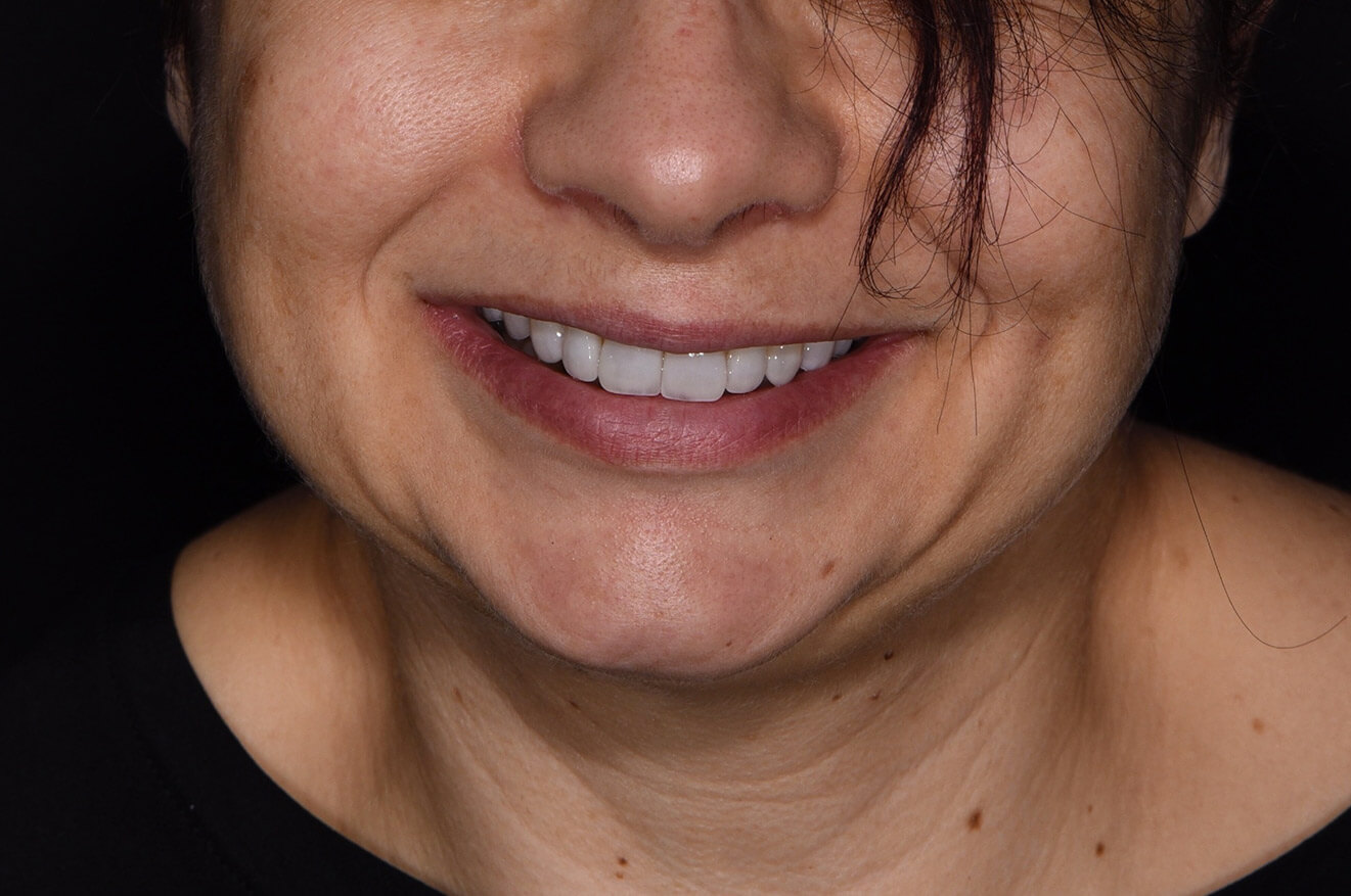 Diastema e faccette dentali