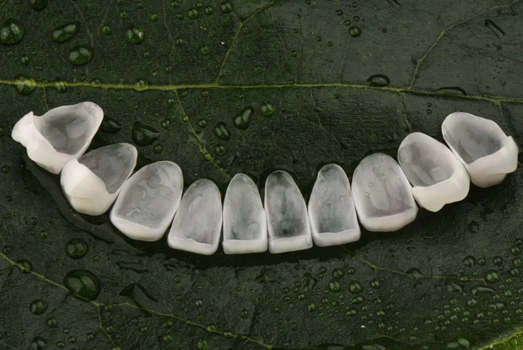 Faccette Dentali: Come Funzionano e Quando Sono la Scelta Giusta