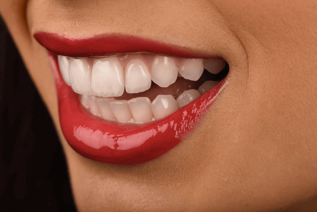 Denti con faccette, Faccette dentali Bologna