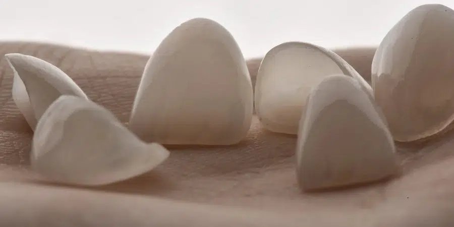Faccette dentali in ceramica, creatività e conoscenze dietro ad un sorriso bellissimo