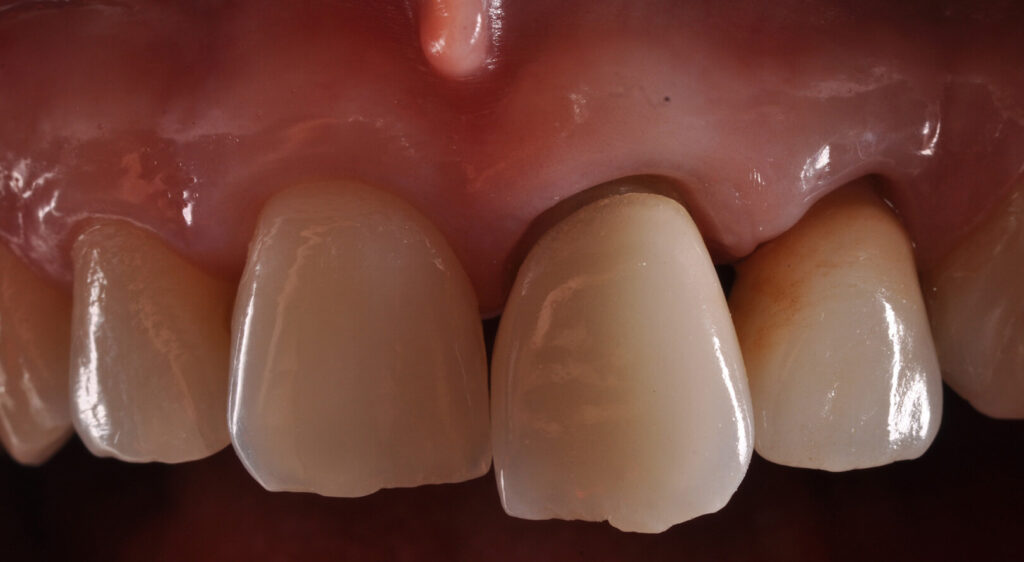 estetica dentale, denti estetici