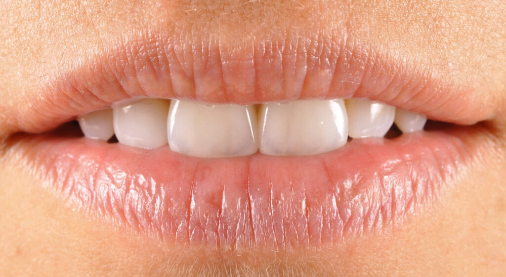 estetica dentale, denti estetici
