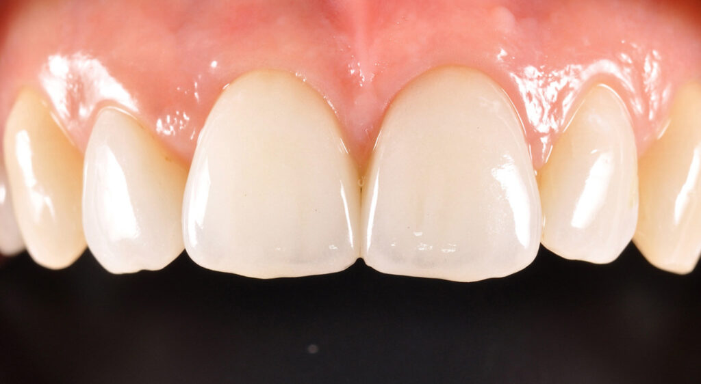 estetica dentale, denti estetici