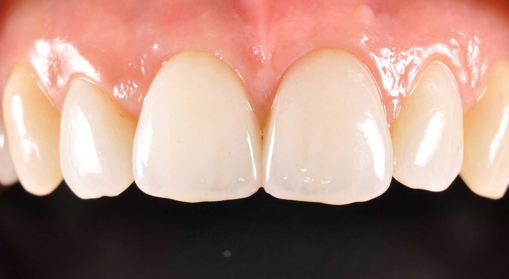 estetica dentale, denti estetici
