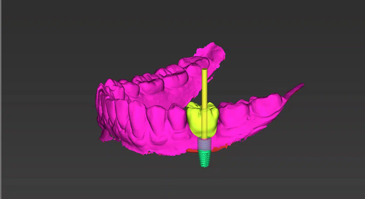 Implantologia Dentale: La Guida Completa per Capire i Vantaggi e le Opzioni