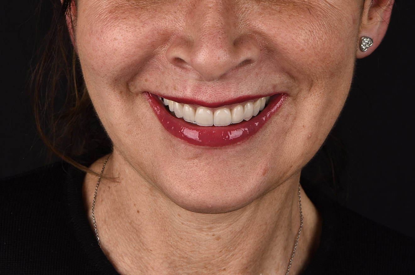Terapia atm e faccette dentali