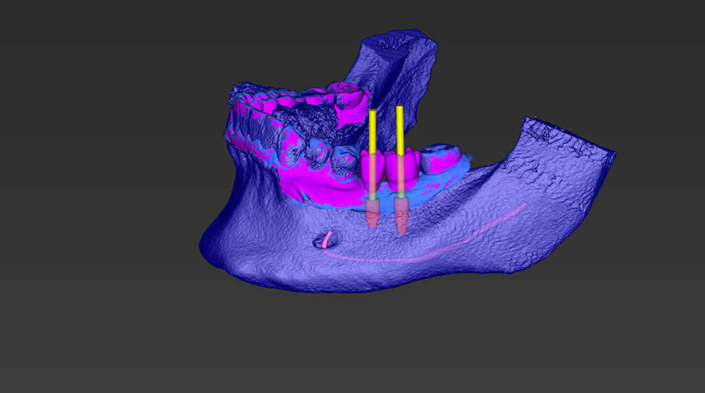 estetica dentale, denti estetici