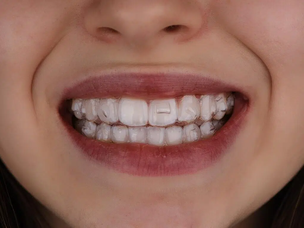 Apparecchio Trasparente: Un Sorriso Sano con l'apparecchio denti trasparente