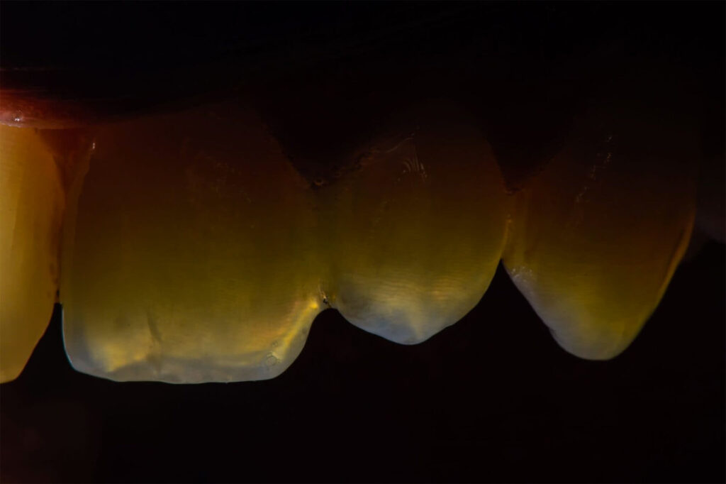 estetica dentale, denti estetici