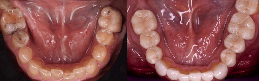 Otturazione Dente: la soluzione migliore per ricostruire denti e mantenere un sorriso naturale 2 Otturazioni estetiche: la soluzione perfetta per un sorriso naturale