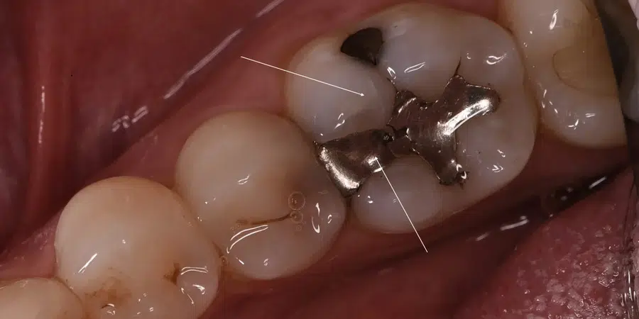 Otturazioni metalliche o otturazioni estetiche adesive?
