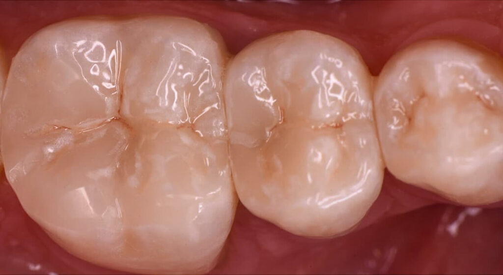 Otturazioni Estetiche 11 Otturazione dente, Otturazione carie, Otturazione estetica