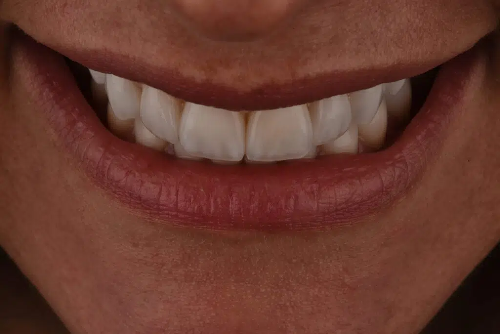 Faccette Dentali quanto durano? Manutenzione delle Faccette Dentarie per una Lunga Durata