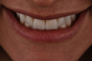 estetica dentale, denti estetici