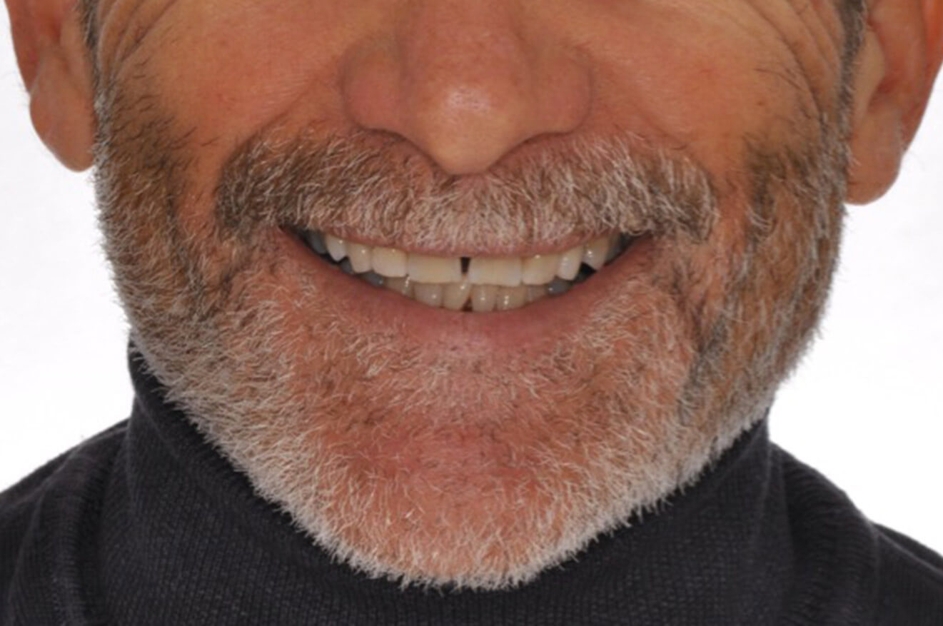 Impianti dentali e faccette in ceramica