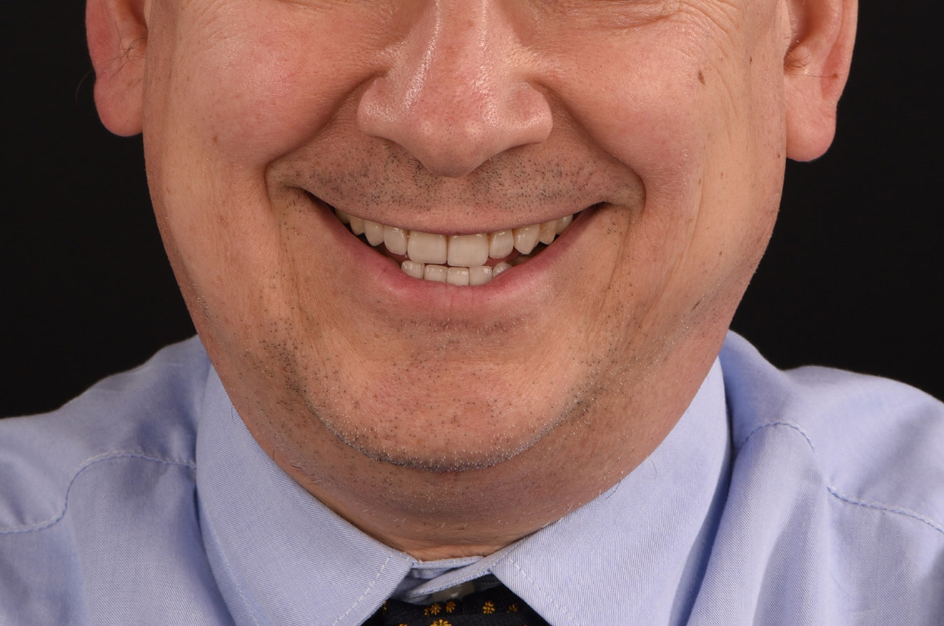 Terapia per usura dentale e faccette dentali in ceramica