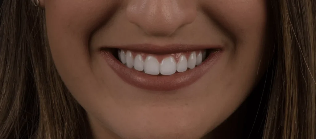 L’importanza dello sbiancamento dentale