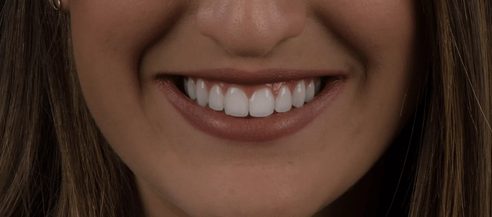 L’importanza dello sbiancamento dentale