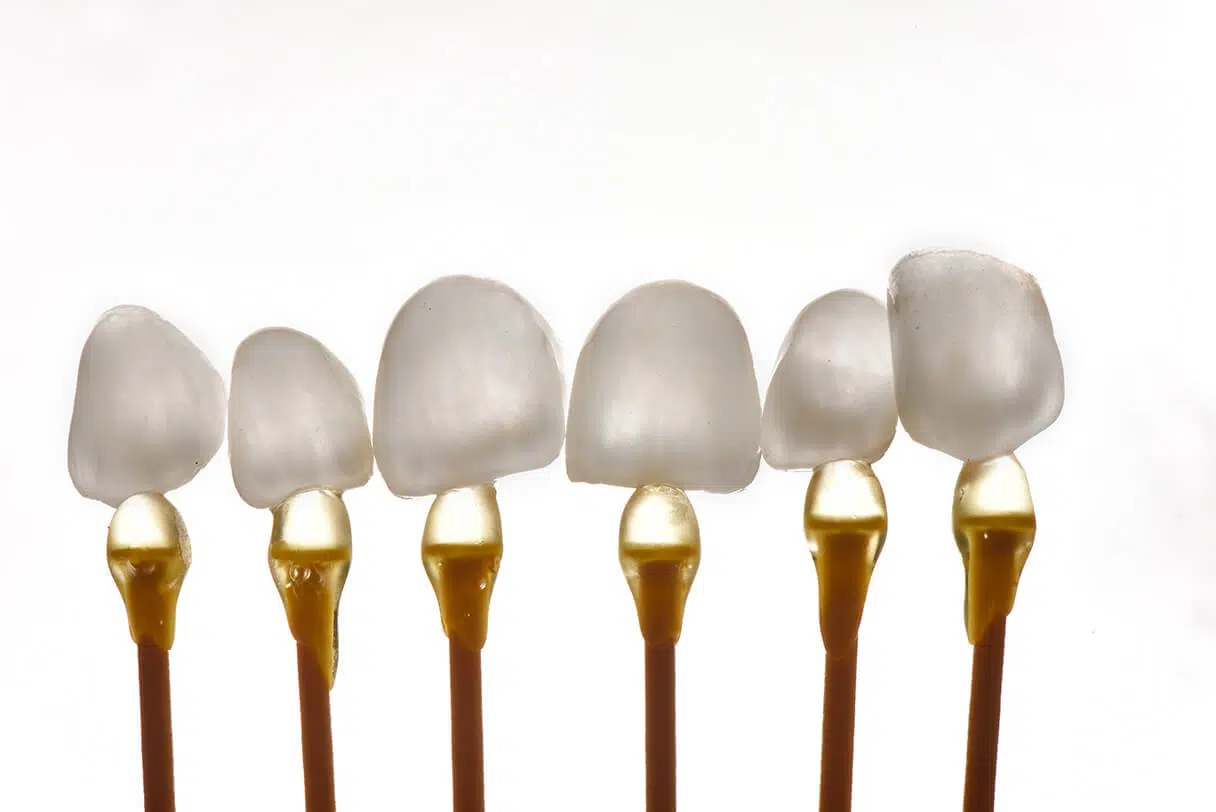 I Vantaggi delle Faccette Dentarie: 5 Motivi per Sceglierle