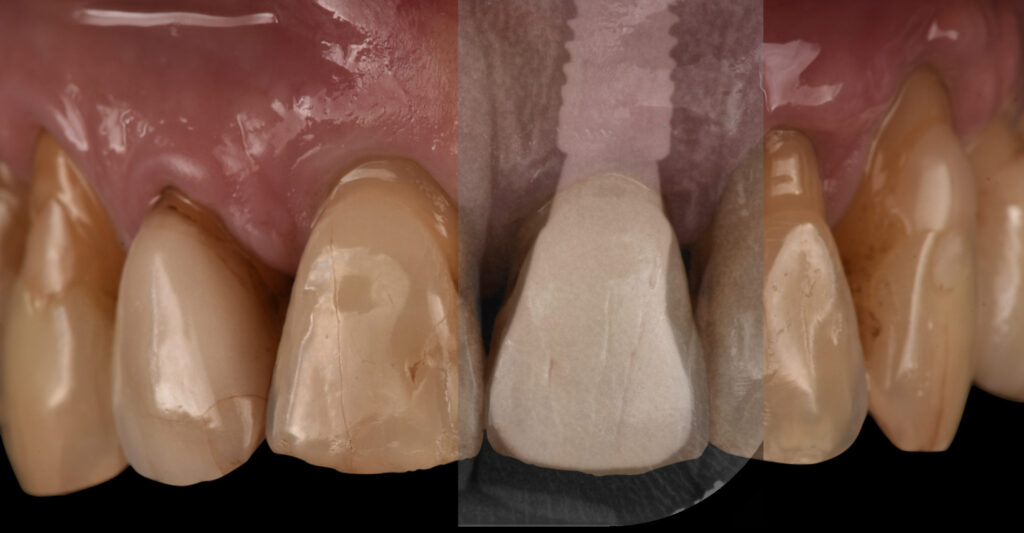 Manutenzione Post-Implantologia: Come Prendersi Cura dei Tuoi Nuovi Denti