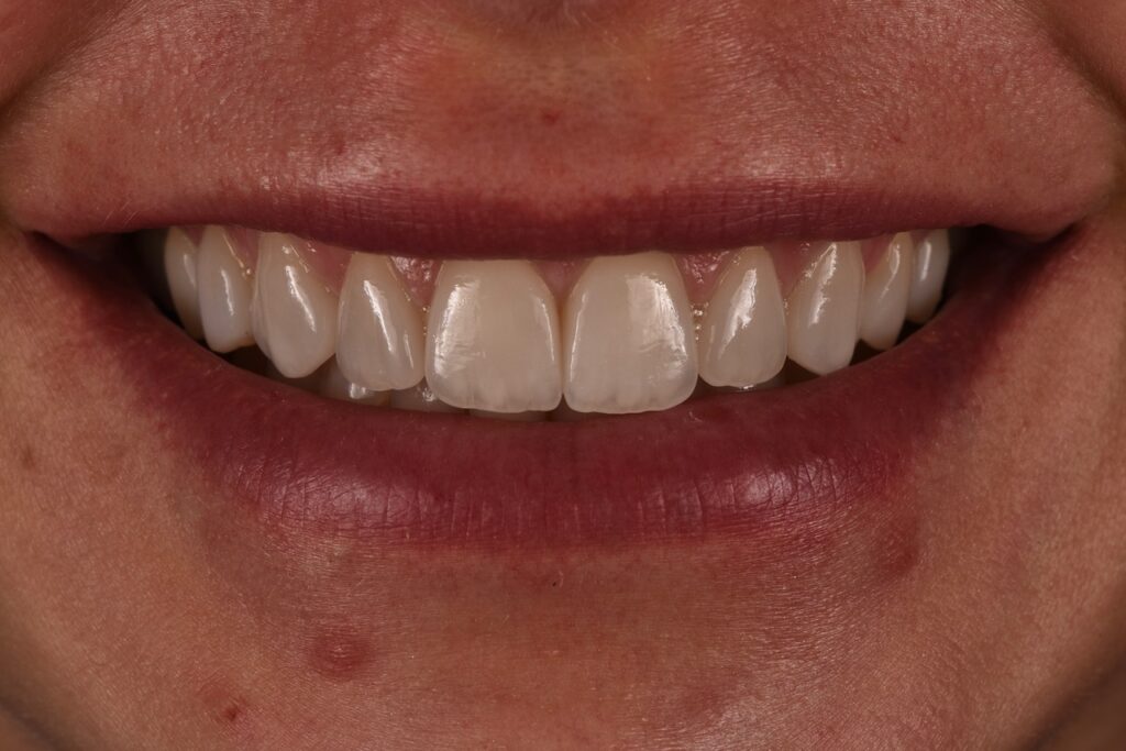 denti usurati, faccette dentali - dopo